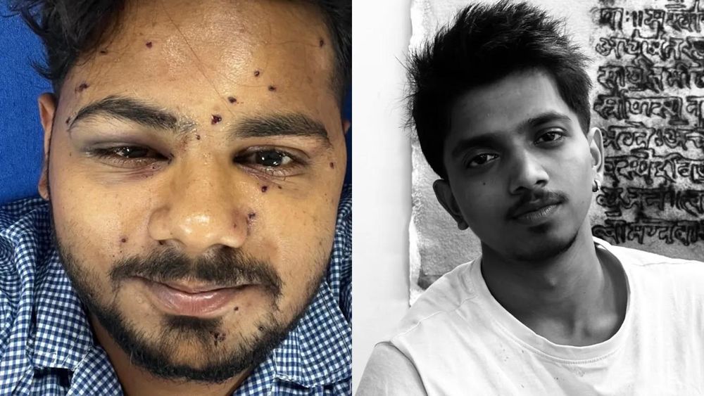 Injured Protesters Move Supreme Court After July 20 Sansad Chalo Firing, Seek Ban on Pellet Guns