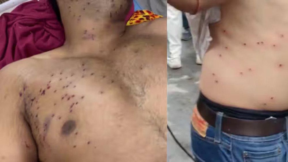 Delhi Protest Crackdown: Teen May Lose Vision as Pellet Injury Allegations Mount; Police Deny Use